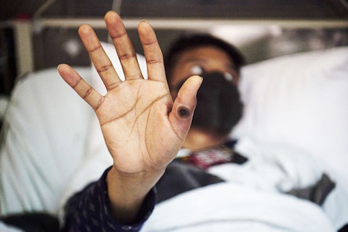 A patient shows his hand with a sore caused by an infection of the monkeypox virus, in the isolation area for monkeypox patients at the Arzobispo Loayza hospital, in Lima on August 16, 2022. Nearly 28,000 cases have been confirmed worldwide in the last three months and the first deaths are starting to be recorded. Image: Ernesto BENAVIDES / AFP A patient shows his hand with a sore caused by an infection of the monkeypox virus, in the isolation area for monkeypox patients at the Arzobispo Loayza hospital, in Lima on August 16, 2022. Nearly 28,000 cases have been confirmed worldwide in the last three months and the first deaths are starting to be recorded. Image: Ernesto BENAVIDES / AFP