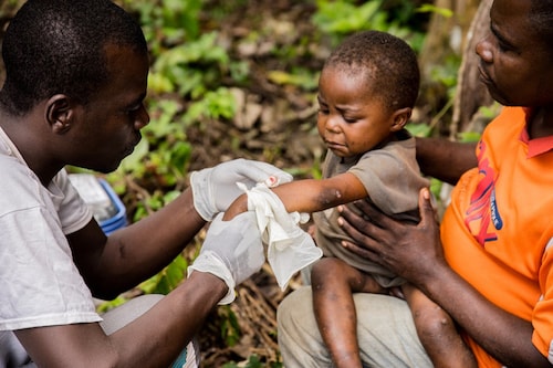 A child affected by monkeypox, sits on his father"s legs while receiving treatment at the centre of the International medical NGO Doctors Without Borders (Medecins sans frontieres - MSF), in Zomea Kaka, in the Lobaya region, in the Central African Republic on October 18, 2018. (Credits: CHARLES BOUESSEL / AFP) A child affected by monkeypox, sits on his father"s legs while receiving treatment at the centre of the International medical NGO Doctors Without Borders (Medecins sans frontieres - MSF), in Zomea Kaka, in the Lobaya region, in the Central African Republic on October 18, 2018. (Credits: CHARLES BOUESSEL / AFP)