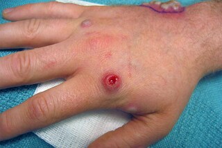 An undated photo provided by VisualDx shows pustules on the hand of a monkeypox patient. Monkeypox symptoms include a rash that eventually becomes raised, growing into pus-filled blisters. (VisualDx via The New York Times)