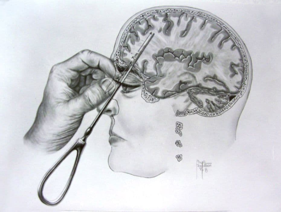 Orbitoclast1935-1967A lobotomy was a surgical procedure where nerves in the front of the brain were 